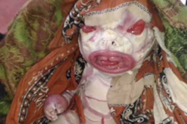 alien-baby-mum-india-birth-defect-harlequin-type-ichthyosis-doctors-hospital-curse-bihar-581087