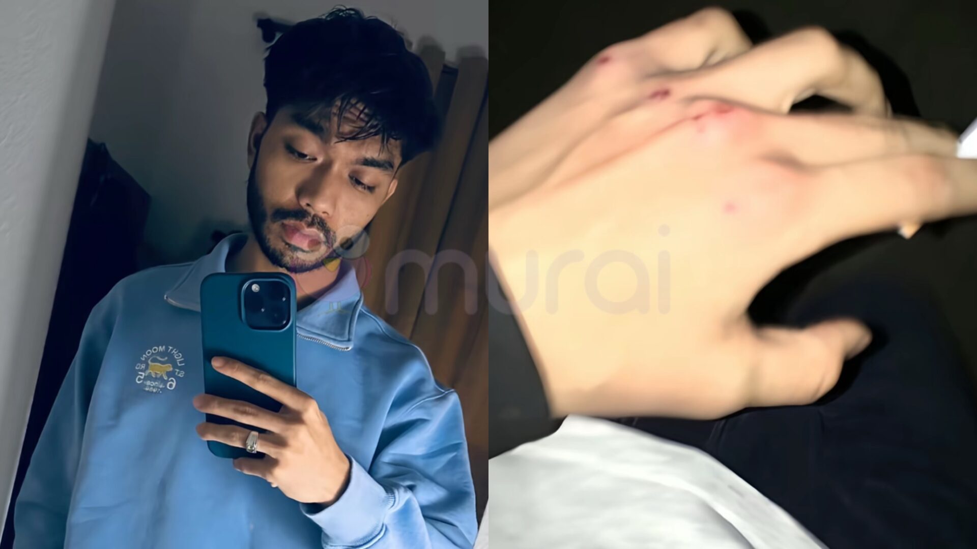 Haqiem Stopa ‘Upload’ Foto Tangan Luka, Lain Pula Reaksi Netizen?-“Second Slide Tu..”